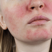 Rosácea, couperosis y peeling