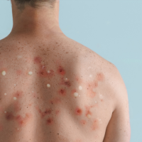 Infecciones por parásitos en piel