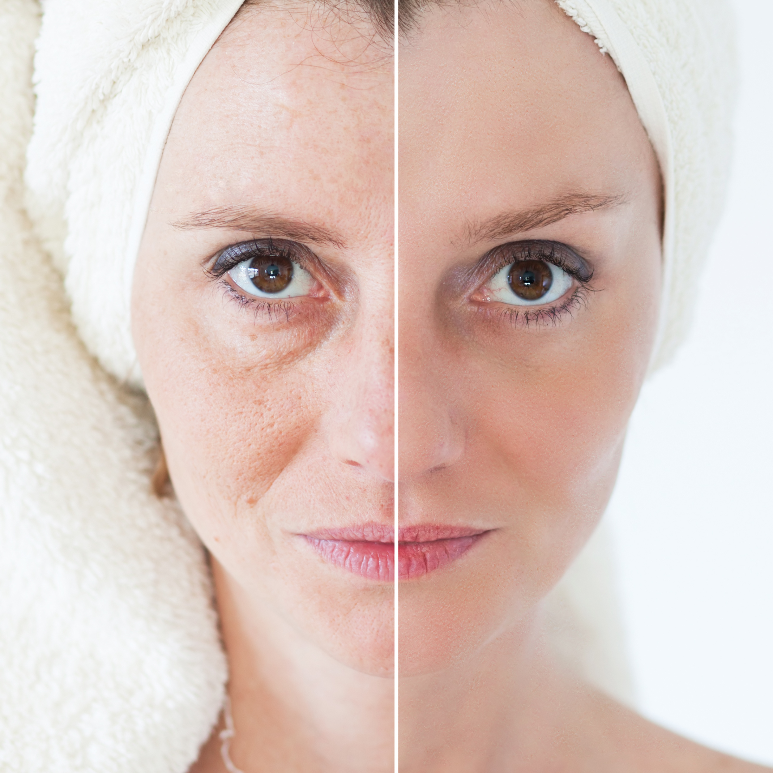 Rejuvenecimiento facial